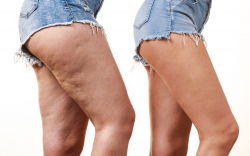 How to slim down and fight cellulite with essential oils