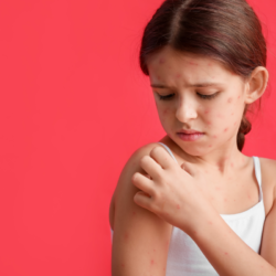une jeune fille atteinte de varicelle qui se gratte l'épaule. quels sont les remèdes naturels pour lutter contre la varicelle ?