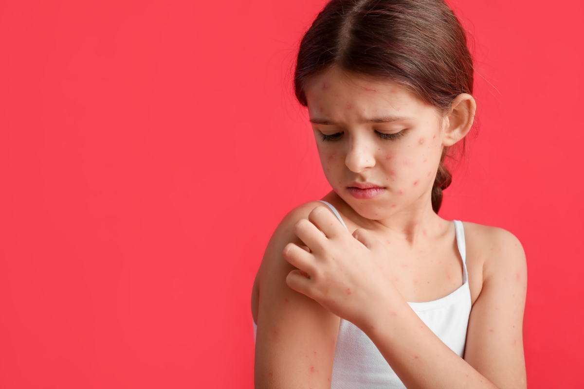 une jeune fille atteinte de varicelle qui se gratte l'épaule. quels sont les remèdes naturels pour lutter contre la varicelle ?