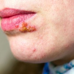Herpes or cold sore, from the naturopathic point of view