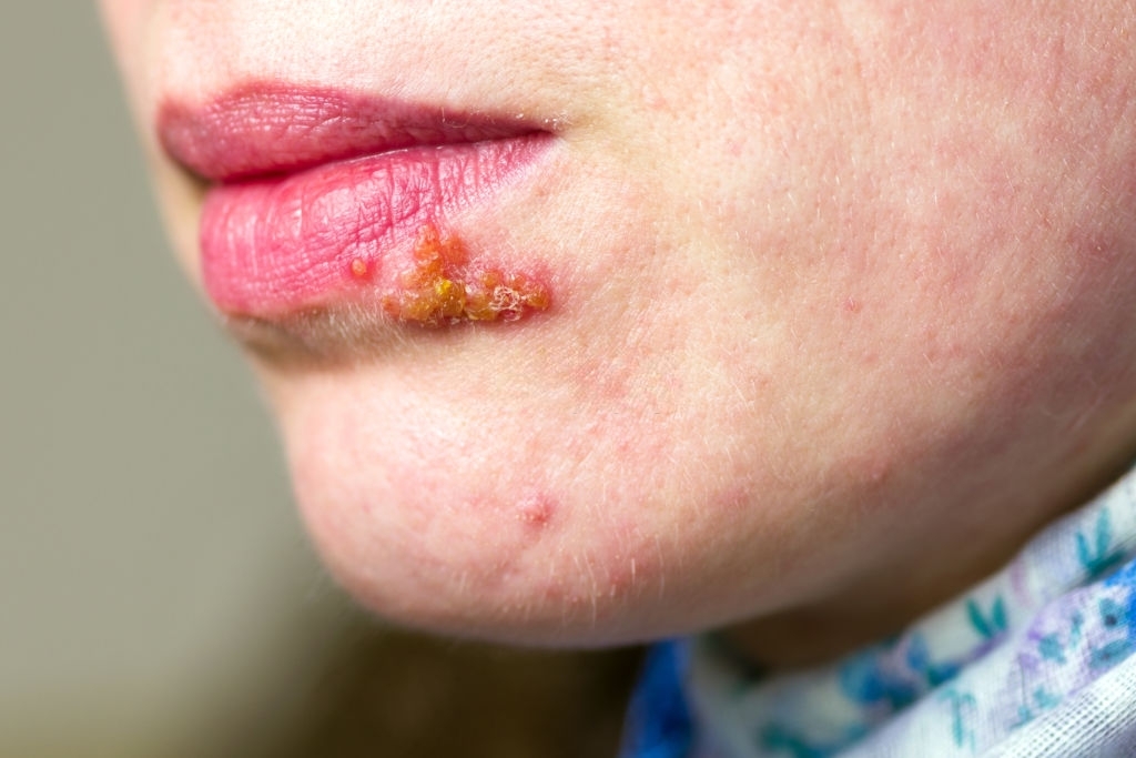 Herpes or cold sore, from the naturopathic point of view