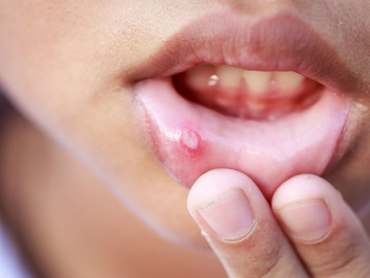 L'image représente une personne qui tient sa lèvre inférieure pour montrer qu'elle a un aphte.