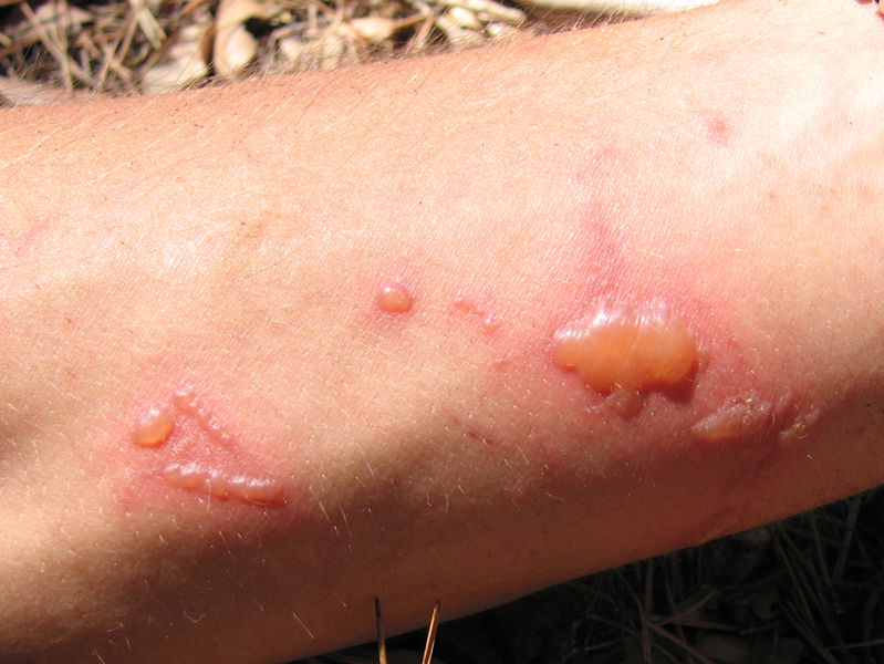 Comment soigner une brûlure de peau