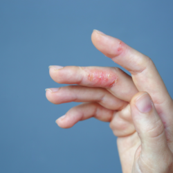 Gros plan sur une main présentant une éruption cutanée et des plaques de peau sèche et craquelée entre les doigts, suggérant des symptômes d'eczéma ou de réactions allergiques cutanées
