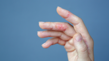 Comment soigner les allergies naturellement avec la Naturopathie ?