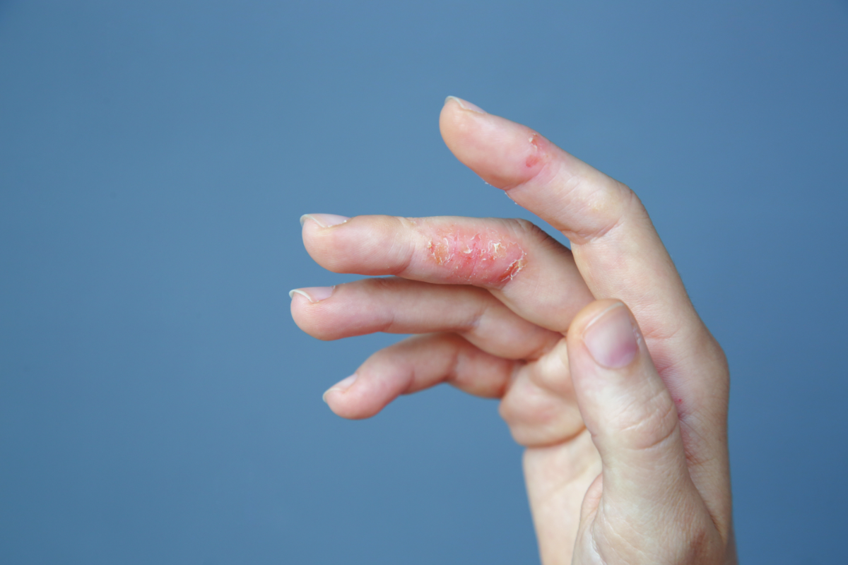 Gros plan sur une main présentant une éruption cutanée et des plaques de peau sèche et craquelée entre les doigts, suggérant des symptômes d'eczéma ou de réactions allergiques cutanées
