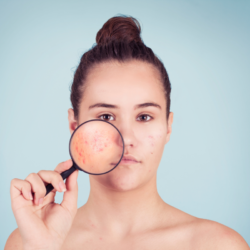 Une jeune femme tenant une loupe devant son visage, révélant des lésions inflammatoires typiques de l'acné, y compris des papules et des pustules, sur un fond bleu clair.