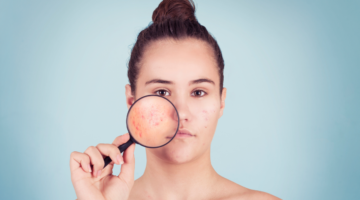 Acne, que remédios naturais para tratá-lo efetivamente?