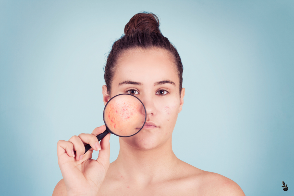 Une jeune femme tenant une loupe devant son visage, révélant des lésions inflammatoires typiques de l'acné, y compris des papules et des pustules, sur un fond bleu clair.