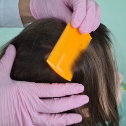 Un pettine per pidocchi che scivola sui capelli del bambino per individuare ed eliminare le lendini, un metodo naturale che non utilizza insetticidi.