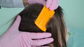 5 natürliche Tipps zur Bekämpfung von Läusen