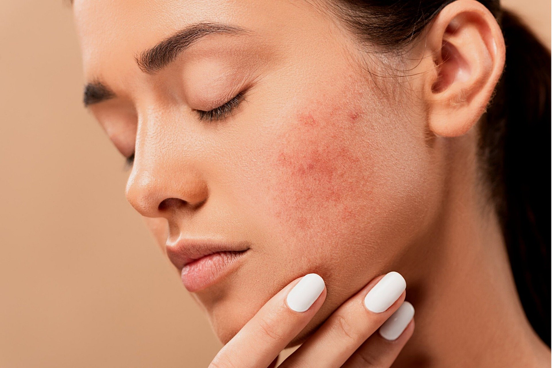 L'image représente une femme souffrant d'acné. Elle présente de nombreuses papules rouges sur les joues.