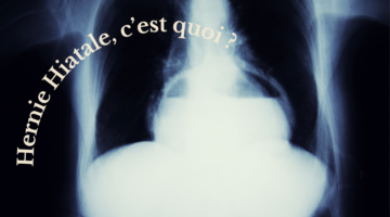 Die Hiatushernie im Herzen natürlicher Behandlungen