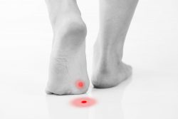 get rid of warts the natural way