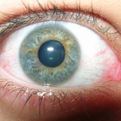 natuurlijke behandeling voor droge ogen