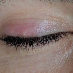 natural remedies to treat stye and chalazion