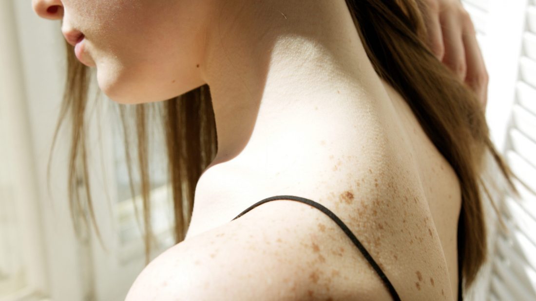 Wie kann man Hautkrebs vorbeugen?