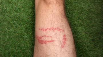 Natural remedies for jellyfish stings