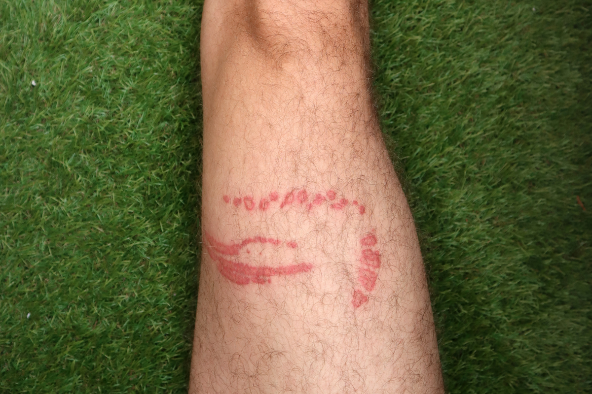 Jellyfish sting on a man's leg, leaving a red mark in the shape of a tentacle, against a background of green grass.