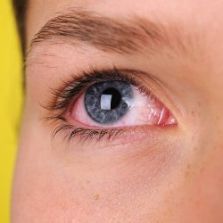 Homeopathic medicines to choose to relieve conjunctivitis