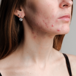 Profil d'une femme avec des marques visibles d'acné sur le visage, notamment sur la joue et le menton, symbolisant le sujet de l'acné d'adulte et la recherche de solutions naturelles pour y remédier.