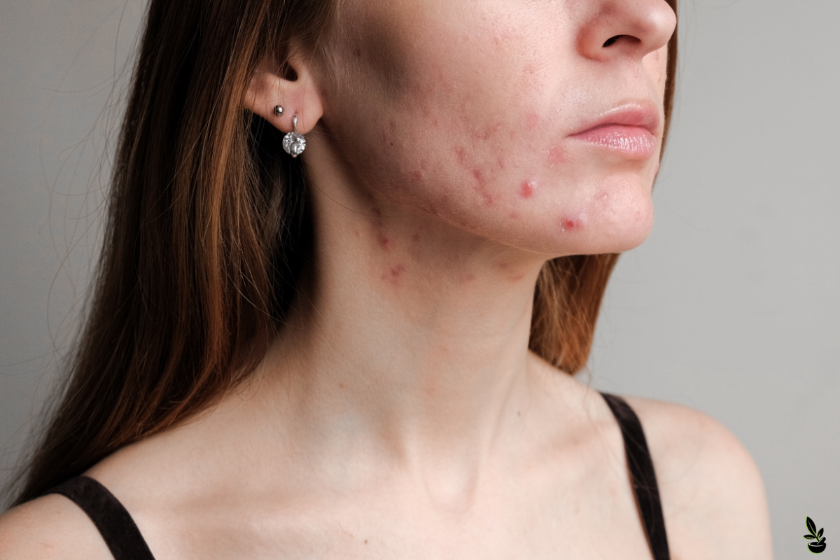 Profil d'une femme avec des marques visibles d'acné sur le visage, notamment sur la joue et le menton, symbolisant le sujet de l'acné d'adulte et la recherche de solutions naturelles pour y remédier.