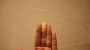 Omeopatia nell'acrocianosi e nella sindrome di Raynaud