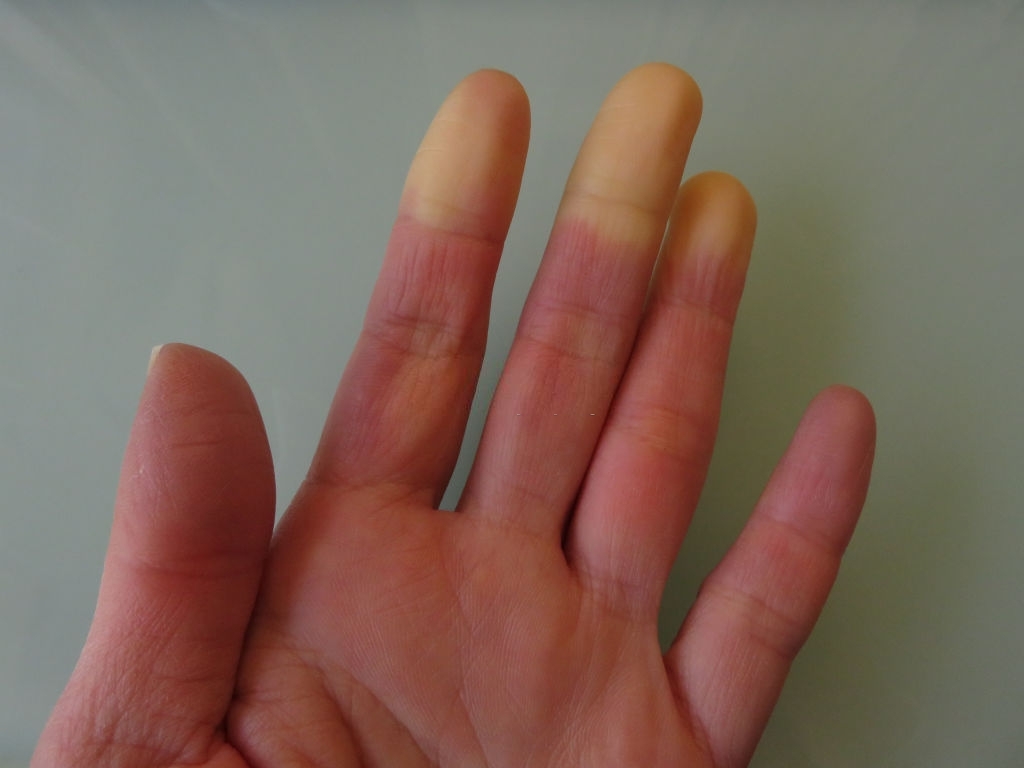 Homeopathy in acrocyanosis and Raynaud&amp;#39;s syndrome