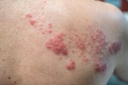 homeopathic treatment for shingles