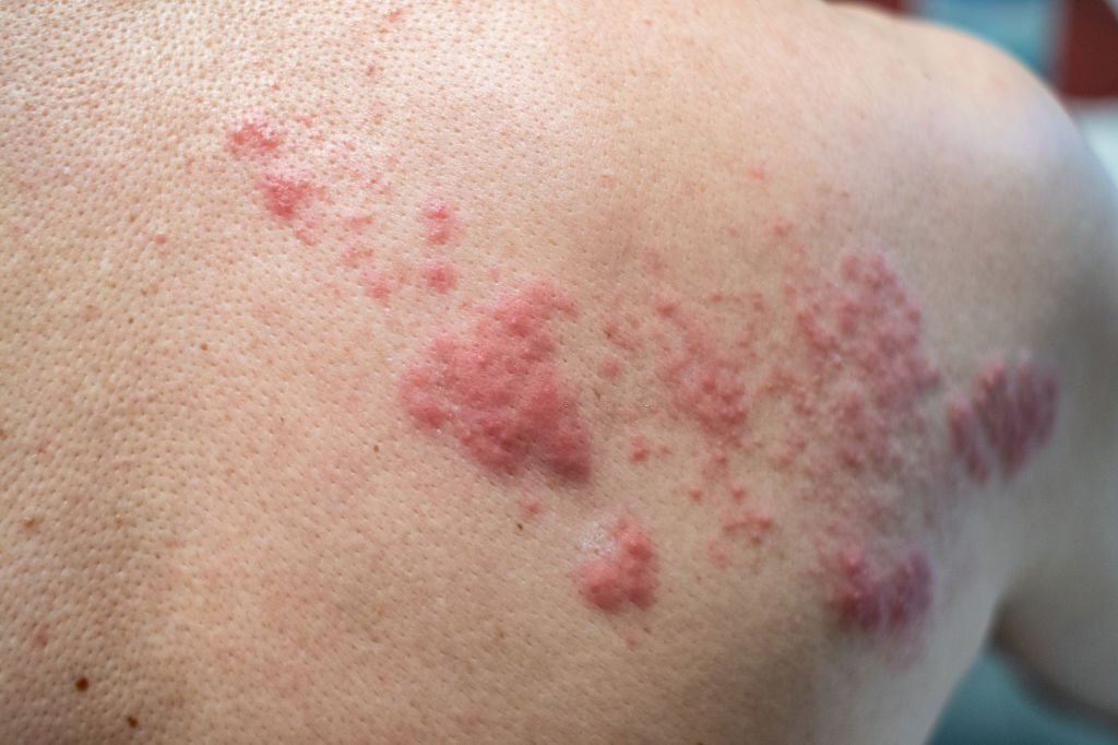 homeopathic treatment for shingles