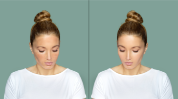 Brown spots above the upper lip: How to get rid of them