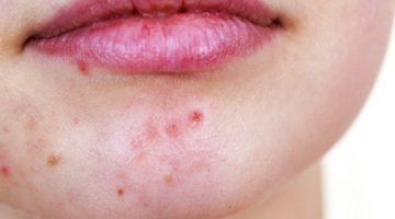 Mascné: Akne unter meiner Maske