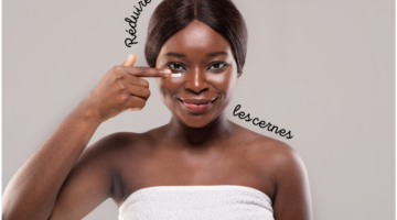 What are the different types of dark circles?