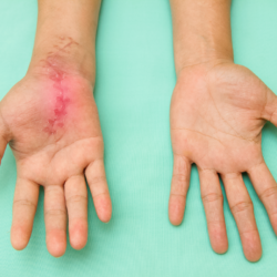 L'image représente deux mains sur un fond bleu vert. La main située à gauche de l'image présente une cicatrice. Comment traiter une cicatrice hypertrophique et une cicatrice chéloïde