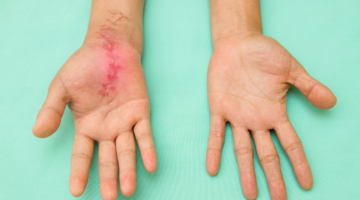 How are hypertrophic and keloid scars treated?