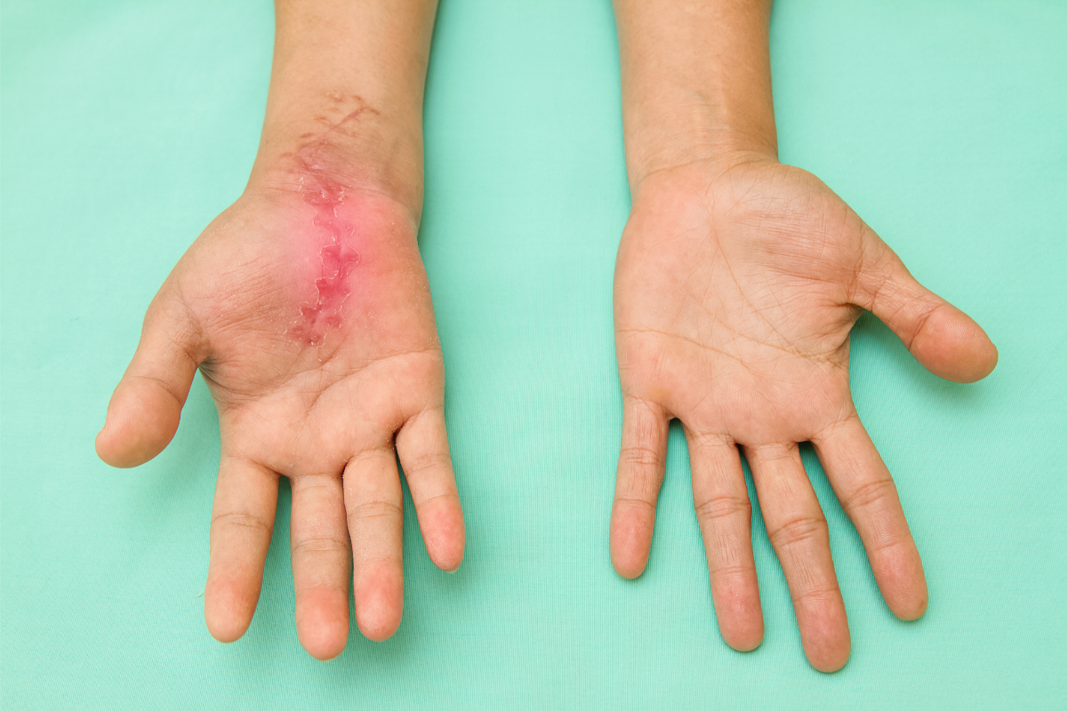 Comment traiter une cicatrice hypertrophique et une cicatrice chéloïde