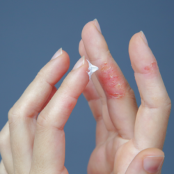 Une main applique délicatement une crème blanche sur l'index de l'autre main, qui présente des signes de dermatite atopique caractérisés par une peau rouge, enflammée et desquamée, illustrant le traitement topique des symptômes de l'eczéma.