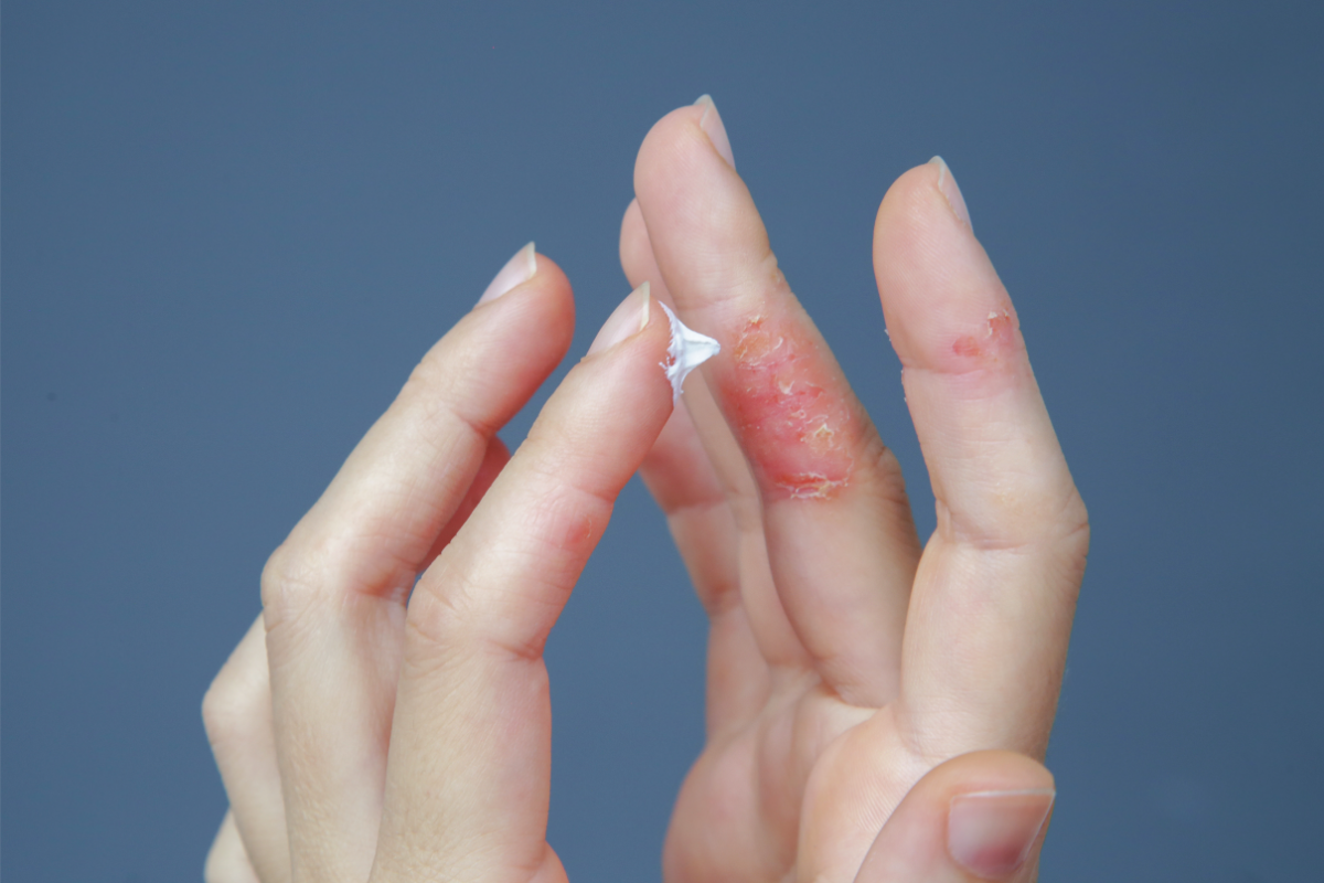 Une main applique délicatement une crème blanche sur l'index de l'autre main, qui présente des signes de dermatite atopique caractérisés par une peau rouge, enflammée et desquamée, illustrant le traitement topique des symptômes de l'eczéma.