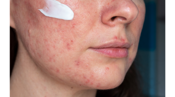 Discover the benefits of coriander seed oil for sensitive skin