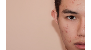 Adolescentes, acne e probióticos: a luta contra a acne