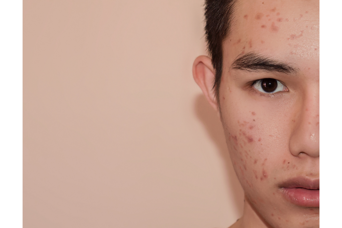L'image représente un ado avec de l'acné sur le visage. Adolescents, acné et probiotiques Une solution naturelle pour lutter contre l'acné chez les adolescents