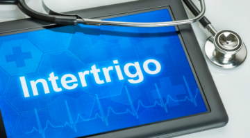 Wie kann man Intertrigo vorbeugen?