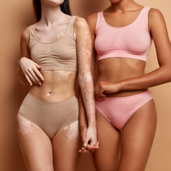 L'image représente deux femmes en sous vêtements, l'une d'entre elles est atteinte de vitiligo. Vitiligo et acariens Nouvelle découverte scientifique