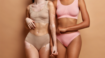 Vitiligo and mites: New scientific discovery