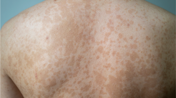 How can Pityriasis versicolor be treated naturally?