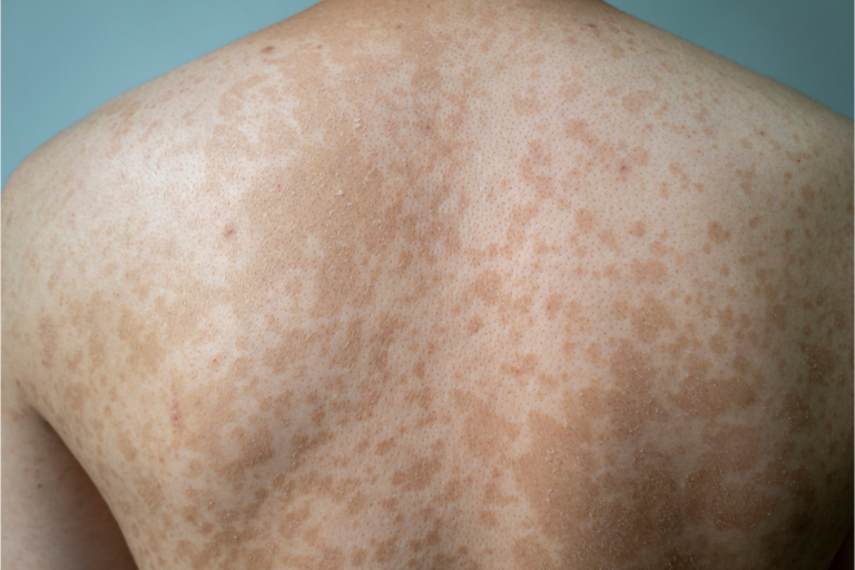 Pityriasis versicolor Les traitements naturels qui fonctionnent