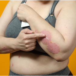 Personne souffrant de psoriasis appliquant un traitement sur des lésions cutanées au niveau du bras. Cette image illustre l'impact des maladies inflammatoires de la peau, telles que le psoriasis, qui pourraient bénéficier de nouvelles approches thérapeutiques utilisant les agonistes du GLP-1 en raison de leurs propriétés anti-inflammatoires et immunomodulatrices.