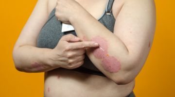 Los beneficios del GLP-1 en las enfermedades cutáneas: un nuevo enfoque de la dermatología médica