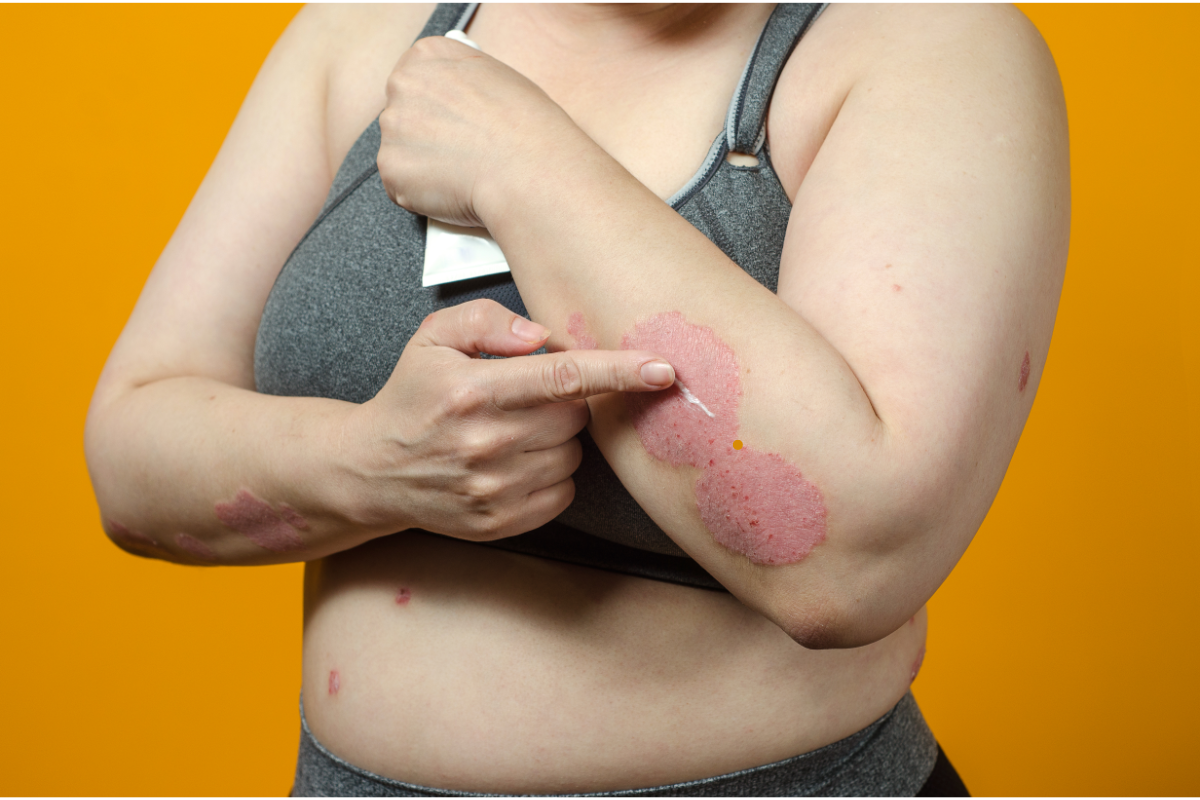 Personne souffrant de psoriasis appliquant un traitement sur des lésions cutanées au niveau du bras. Cette image illustre l'impact des maladies inflammatoires de la peau, telles que le psoriasis, qui pourraient bénéficier de nouvelles approches thérapeutiques utilisant les agonistes du GLP-1 en raison de leurs propriétés anti-inflammatoires et immunomodulatrices.