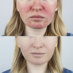 Comparaison avant/après montrant une réduction significative des rougeurs et inflammations du visage liées à la rosacée, soulignant l'efficacité de certains nutriments et vitamines comme la vitamine A, le zinc et les oméga-3 dans l'amélioration des symptômes cutanés.